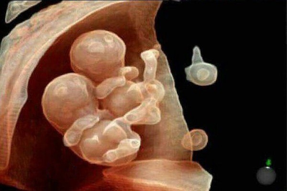 4D – Трехмерное сканирование в режиме реального времени. Выбор аппарата УЗИ.